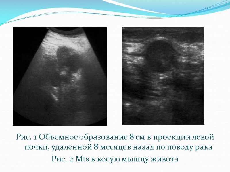 Рис. 1 Объемное образование 8 см в проекции левой почки, удаленной 8 месяцев назад